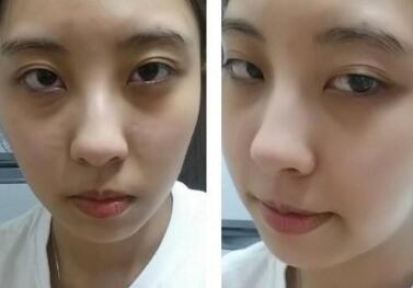 去眼袋前后對比圖