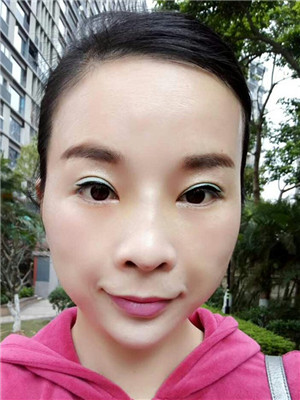 你們來看看我的面部埋埋蛋白線.提升術(shù)恢復情況