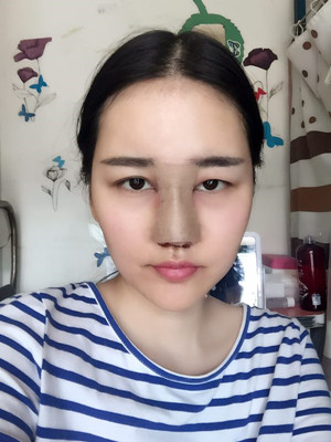 給你們分享隆鼻整形手術(shù)恢復過程