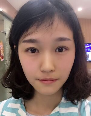 韓式微創(chuàng)雙眼皮恢復(fù)圖，超自然微創(chuàng)跡