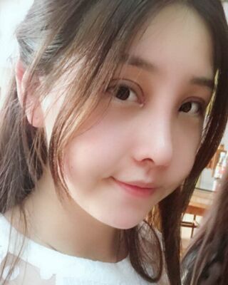 全切雙眼皮+開眼角前后對(duì)比照片圖