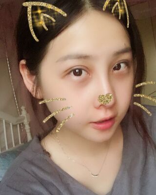 全切雙眼皮+開眼角前后對(duì)比照片圖