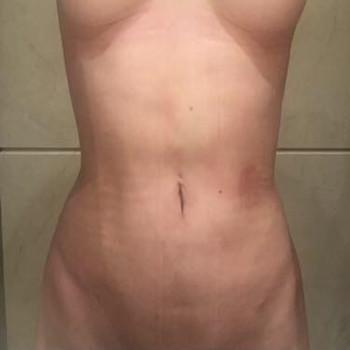 腹部環(huán)吸整形恢復(fù)果圖  我的減肥逆襲史