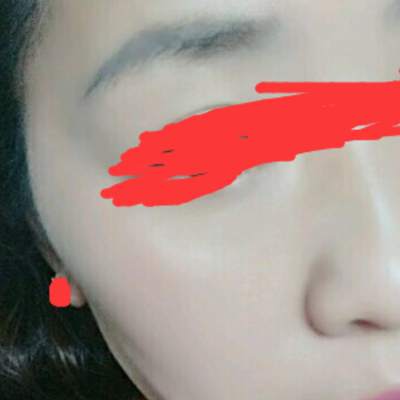 德陽金榮周雪高強(qiáng)度聚焦超聲面b提升案例