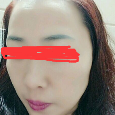 德陽金榮周雪高強(qiáng)度聚焦超聲面b提升案例