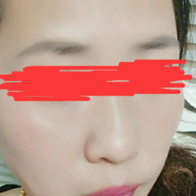 德陽金榮周雪高強(qiáng)度聚焦超聲面b提升案例