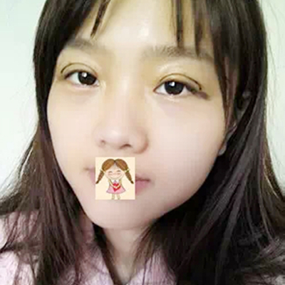 德陽金榮盧元剛埋線雙眼皮案例