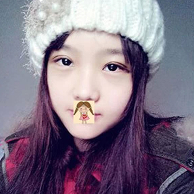 德陽金榮盧元剛埋線雙眼皮案例