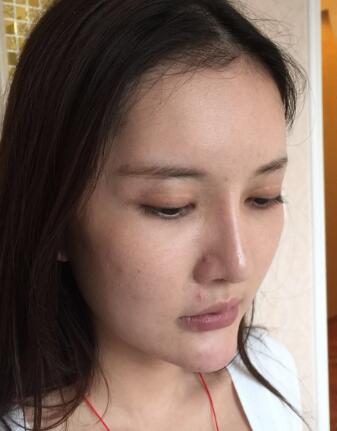 這是我做埋埋蛋白線.提升前拍的照片，看得出來面部肌膚走向下垂，皮膚松弛了