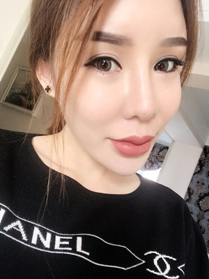 高強(qiáng)度聚焦超聲手術(shù)三個(gè)月的前后恢復(fù)記錄——?？诩t妝李科做的