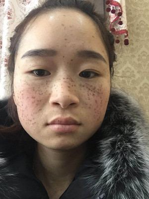 激光祛雀斑真實案例以及前后對比圖分享——?？诩t妝李杰做的