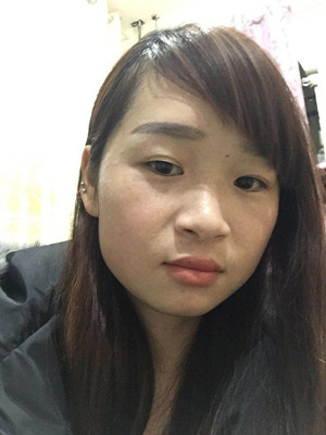 激光祛雀斑真實案例以及前后對比圖分享——海口紅妝李杰做的