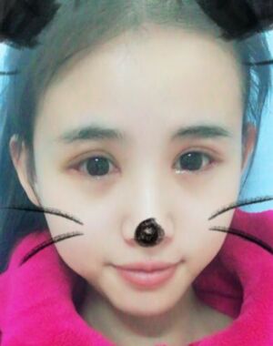 三點(diǎn)定位雙眼皮恢復(fù)實(shí)例，張永義做的