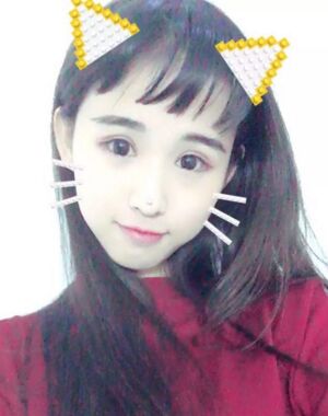 三點(diǎn)定位雙眼皮恢復(fù)實(shí)例，張永義做的