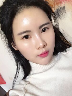 自體脂肪填充全臉經(jīng)歷，臉型超**的