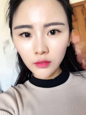 自體脂肪填充全臉經(jīng)歷，臉型超**的