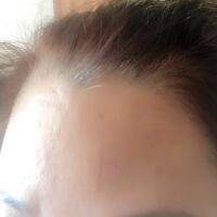 去抬頭紋很好的方法是注射注射瘦臉，恢復(fù)過程圖分享