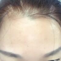 去抬頭紋很好的方法是注射注射瘦臉，恢復(fù)過程圖分享