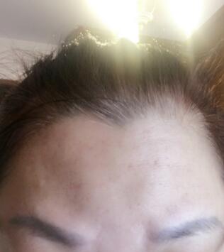 去抬頭紋很好的方法是注射注射瘦臉