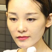 玻尿酸豐太陽穴對比照片和恢復(fù)過程分享