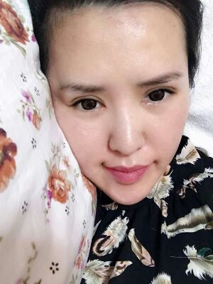 全切雙眼皮修復(fù)恢復(fù)后圖片，寬度較為合適喲