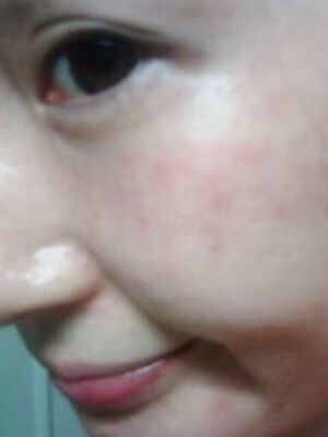 激光去雀斑果好不好，真實(shí)案例告訴你