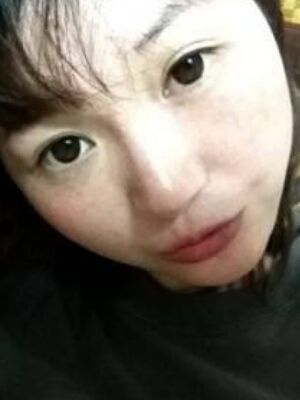 激光去雀斑果好不好，真實(shí)案例告訴你