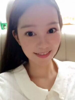 點(diǎn)陣激光祛痘后果對(duì)比圖，皮膚光滑多了