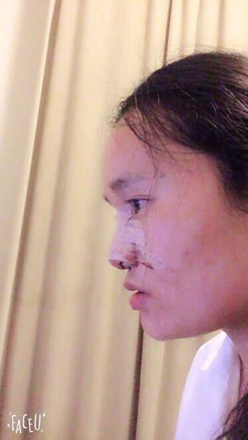 隆鼻整形手術(shù)讓我晉升女神行列 果真的很不錯(cuò)哦