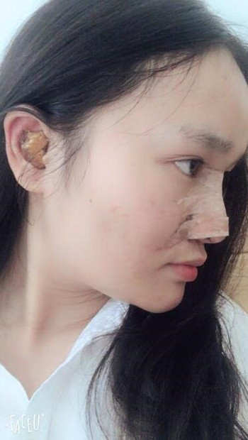 隆鼻整形手術(shù)讓我晉升女神行列 果真的很不錯(cuò)哦