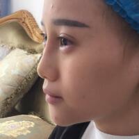 玻尿酸填充臥蠶果對比圖，很滿意