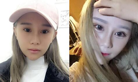 玻尿酸填充臥蠶前后的對(duì)比圖