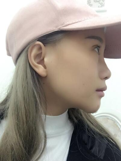 玻尿酸填充臥蠶