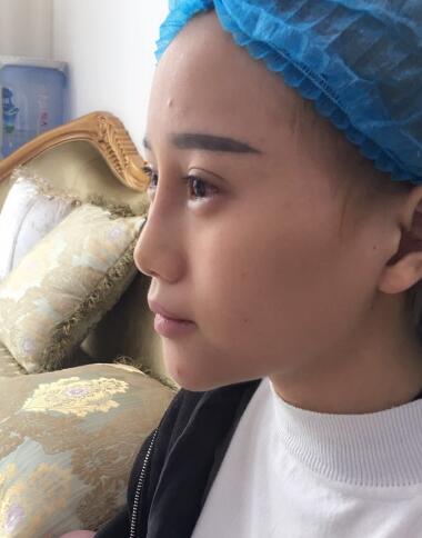 玻尿酸填充臥蠶果對(duì)比圖