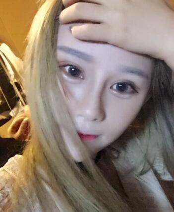 玻尿酸填充臥蠶果對(duì)比圖