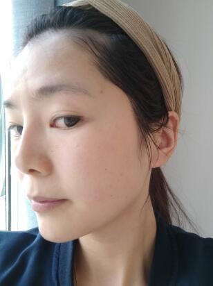 做完光子嫩膚恢復(fù)圖片和過程分享，光子嫩膚價(jià)格3800元