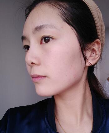 做完光子嫩膚恢復(fù)圖片和過程分享，光子嫩膚價(jià)格3800元