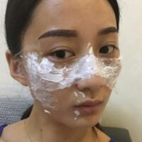 有誰做過激光祛雀斑？個(gè)人激光祛雀斑后恢復(fù)日記分享