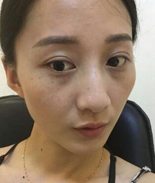 有誰做過激光祛雀斑？個人激光祛雀斑后恢復(fù)日記分享