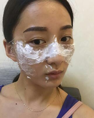 有誰做過激光祛雀斑？個人激光祛雀斑后恢復(fù)日記分享