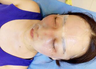 有誰做過激光祛雀斑？個人激光祛雀斑后恢復(fù)日記分享