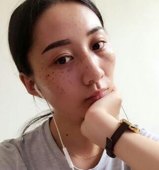 有誰做過激光祛雀斑？個人激光祛雀斑后恢復(fù)日記分享