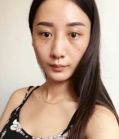 有誰做過激光祛雀斑？個人激光祛雀斑后恢復(fù)日記分享