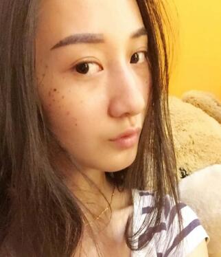 有誰做過激光祛雀斑？個人激光祛雀斑后恢復(fù)日記分享