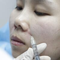 玻尿酸去法令紋后人變年輕了好幾歲