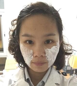 玻尿酸去法令紋后人變年輕了好幾歲