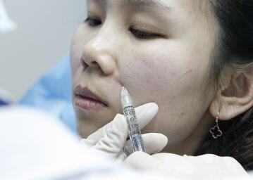 玻尿酸去法令紋后人變年輕了好幾歲