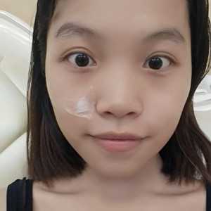 ?？诩t妝李杰醫(yī)生給我做的激光點痣，分享一下前后對比圖片