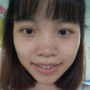 ?？诩t妝李杰醫(yī)生給我做的激光點痣，分享一下前后對比圖片