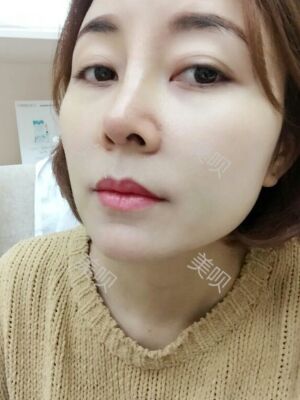 成都隆鼻整形整真實(shí)恢復(fù)圖片，終于有了韓式小翹鼻